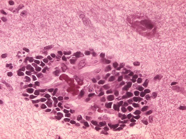 Rabies_encephalitis_PHIL_3368_lores